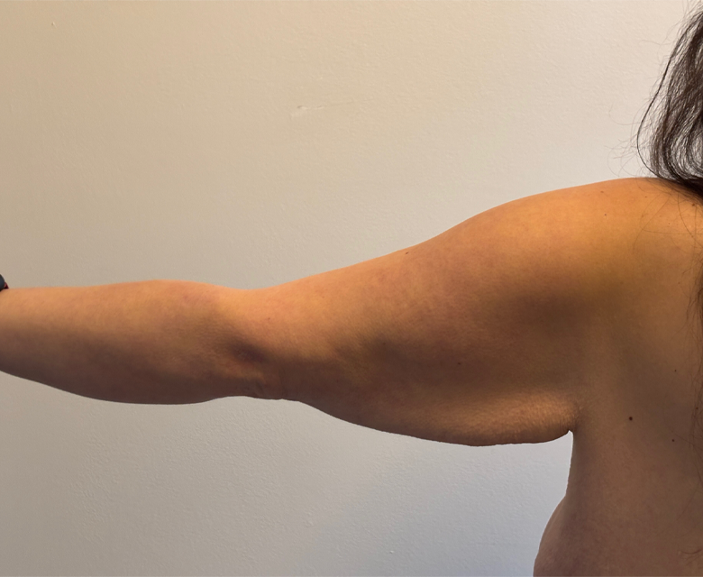 Arm Lift case #4602