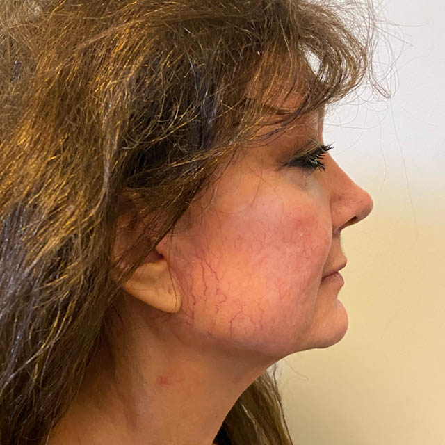 Facelift case #4595