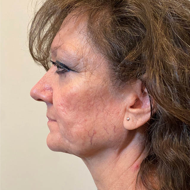Facelift case #4595