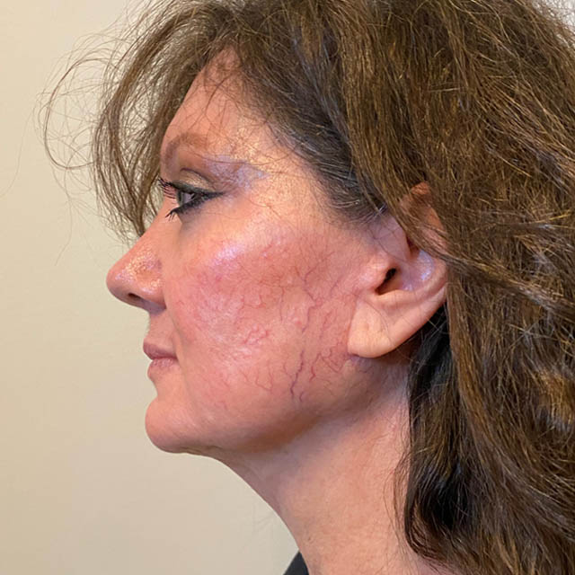 Facelift case #4595
