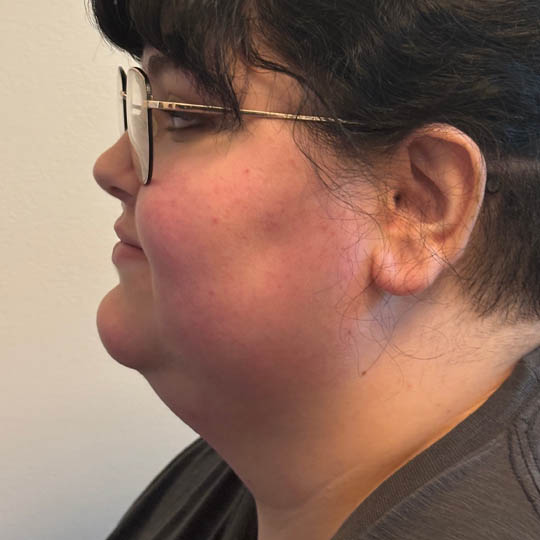 Chin Liposuction case #4747