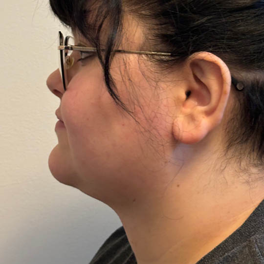 Chin Liposuction case #4747