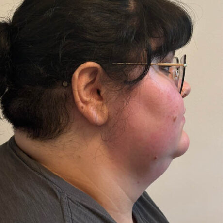 Chin Liposuction case #4747