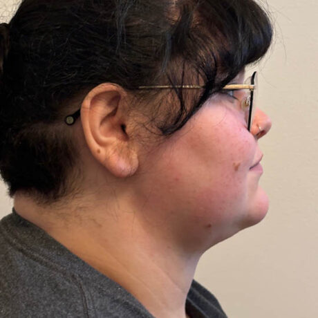Chin Liposuction case #4747