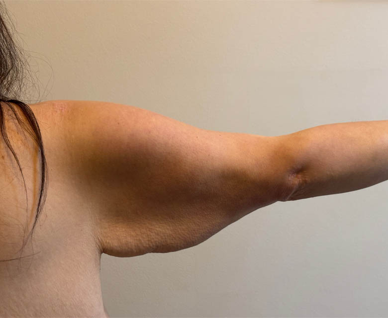 Arm Lift case #4602
