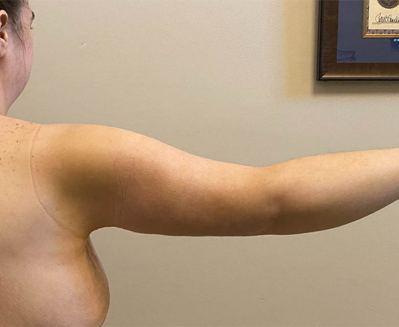 Arm Lift case #4602