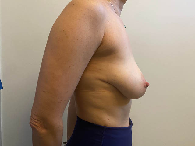 Breast Augmentation case #4633