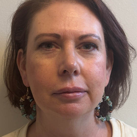 Chin Liposuction case #4760