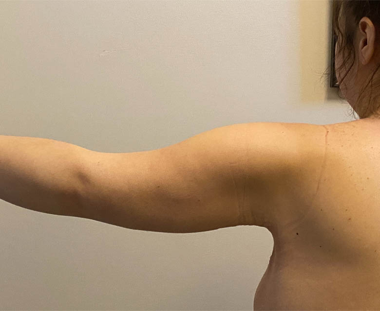 Arm Lift case #4602