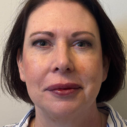 Chin Liposuction case #4760