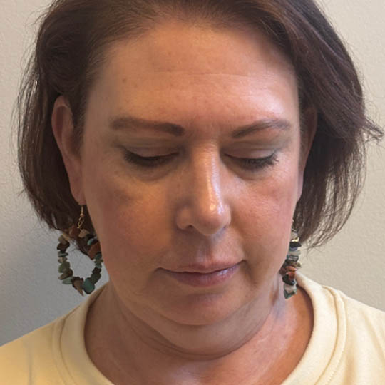 Chin Liposuction case #4760