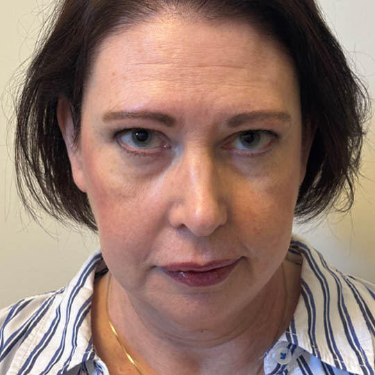 Chin Liposuction case #4760