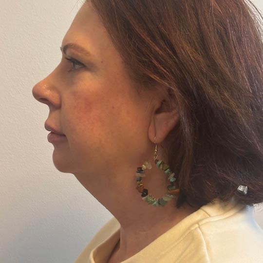 Chin Liposuction case #4760