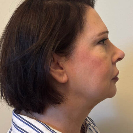 Chin Liposuction case #4760