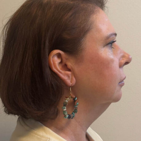 Chin Liposuction case #4760