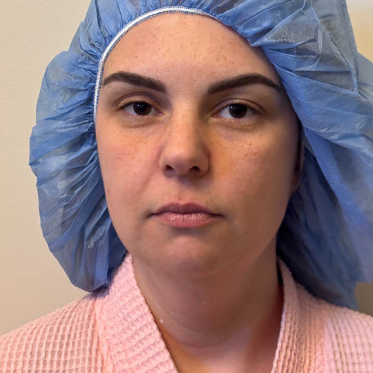Chin Liposuction case #4771