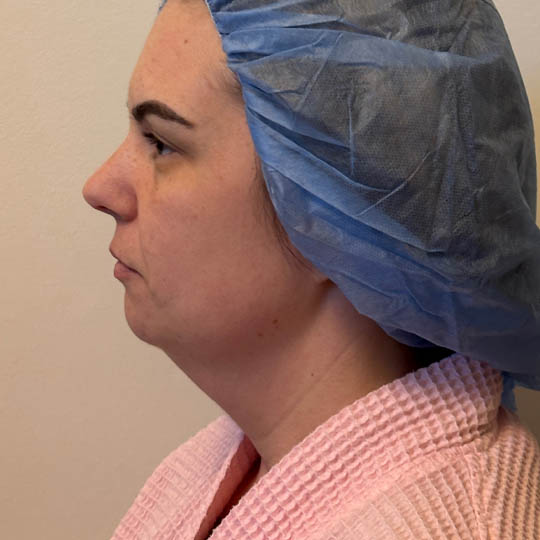 Chin Liposuction case #4771