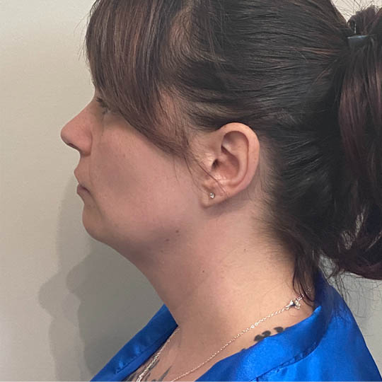 Chin Liposuction case #4771