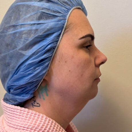 Chin Liposuction case #4771