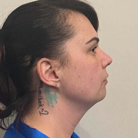 Chin Liposuction case #4771
