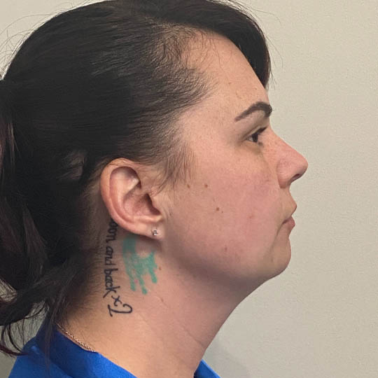 Chin Liposuction case #4771