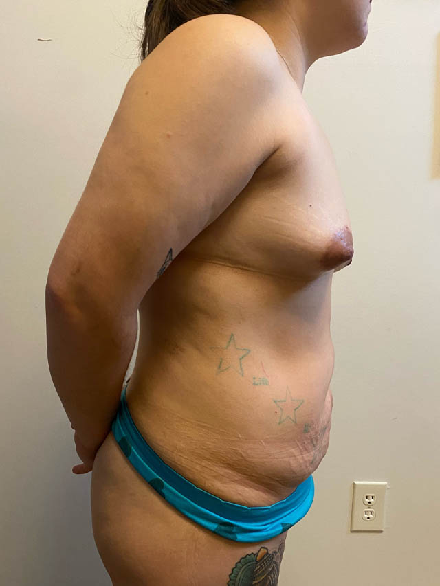 Mommy Makeover case #4819