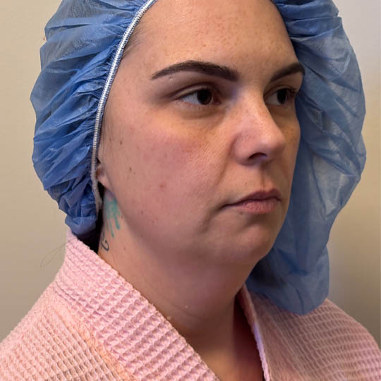 Chin Liposuction case #4771