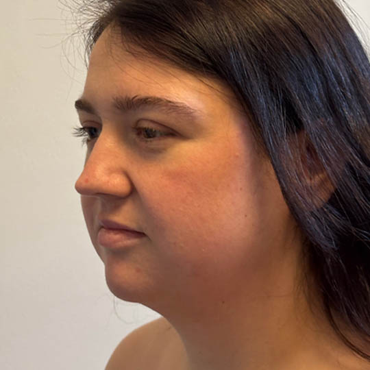 Chin Liposuction case #4782