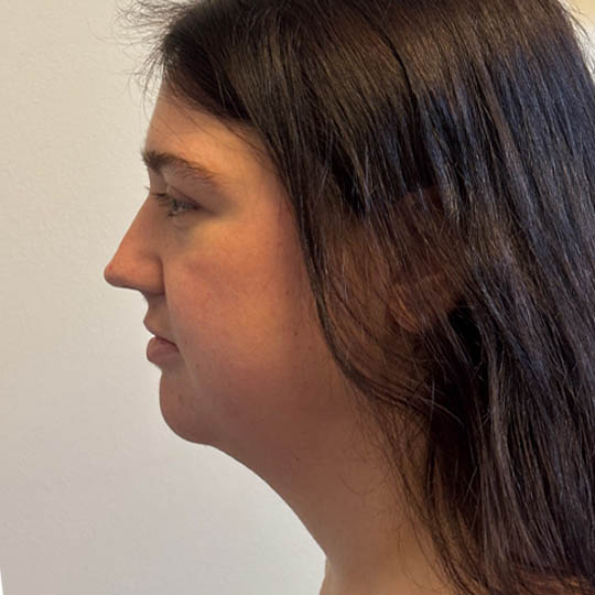 Chin Liposuction case #4782