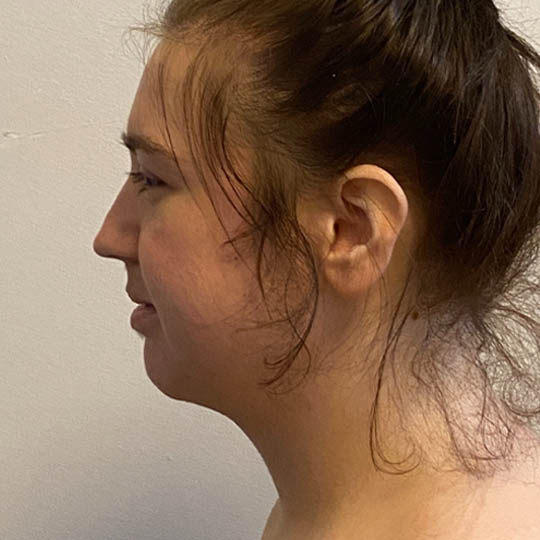 Chin Liposuction case #4782