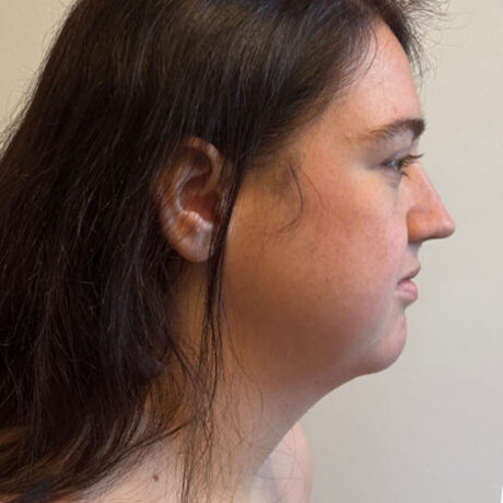 Chin Liposuction case #4782