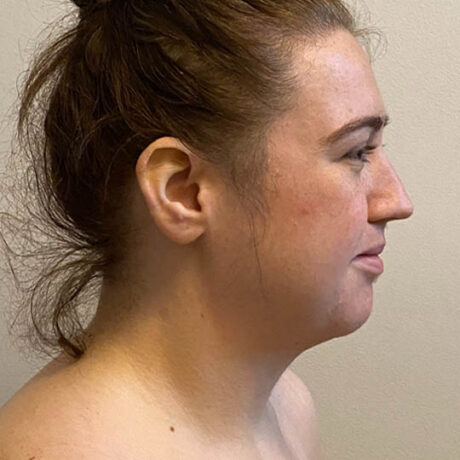 Chin Liposuction case #4782