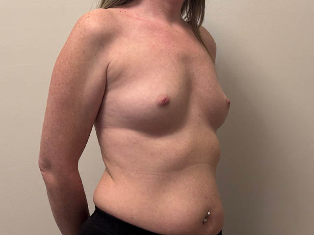 Breast Augmentation case #4662