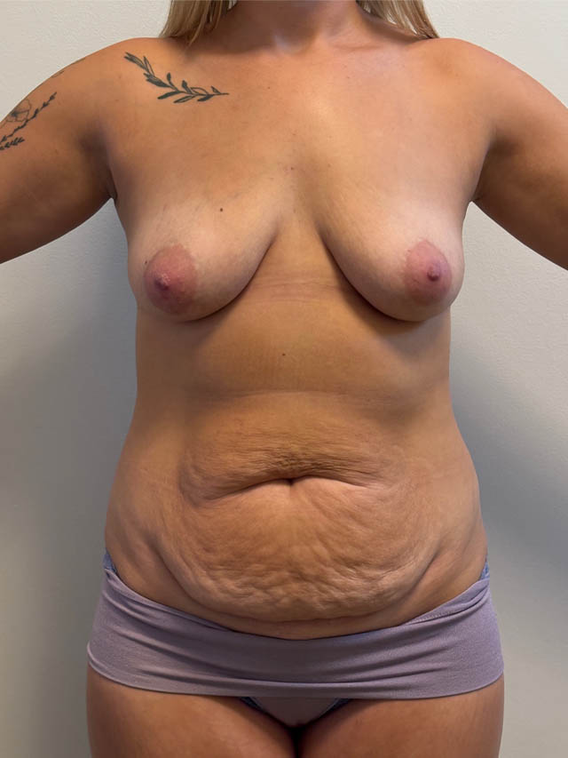 Mommy Makeover case #4841