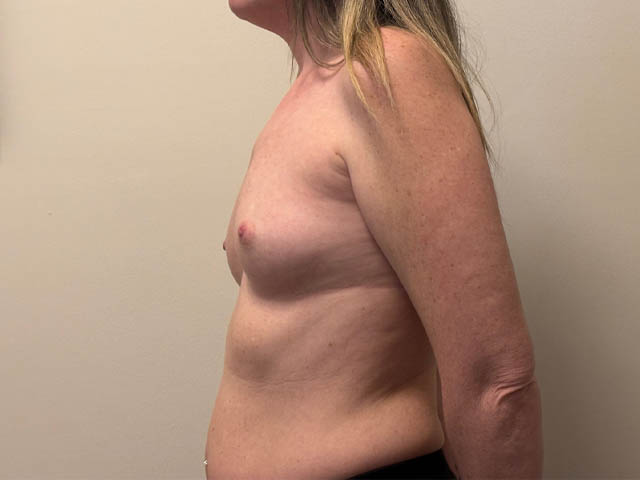 Breast Augmentation case #4662