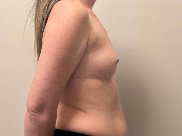Breast Augmentation case #4662