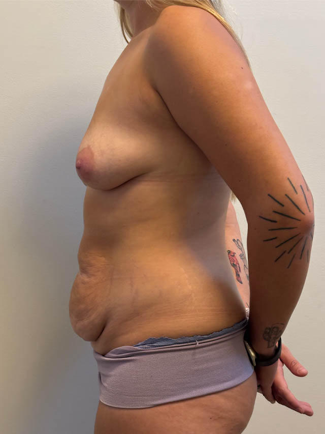 Mommy Makeover case #4841