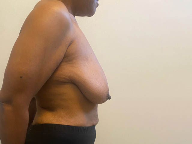 Breast Lift case #4673