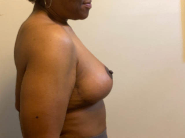 Breast Lift case #4673