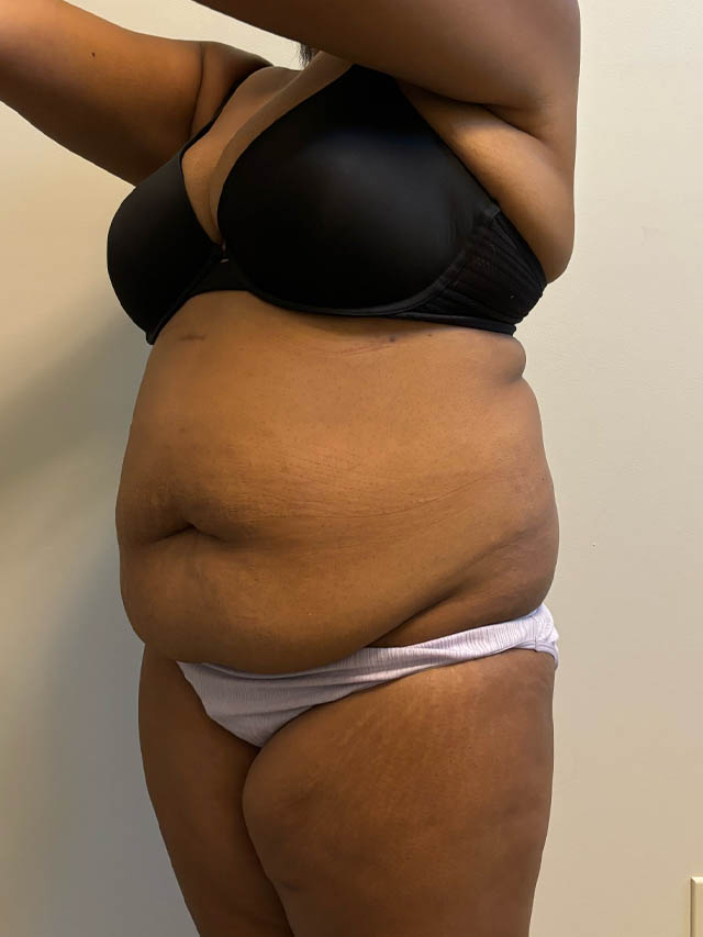 Tummy Tuck case #4852