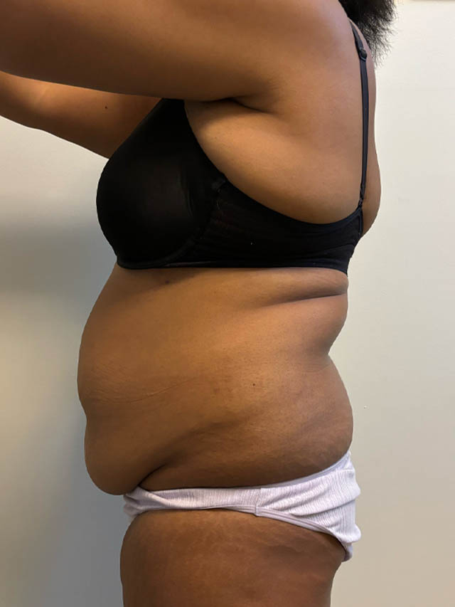 Tummy Tuck case #4852