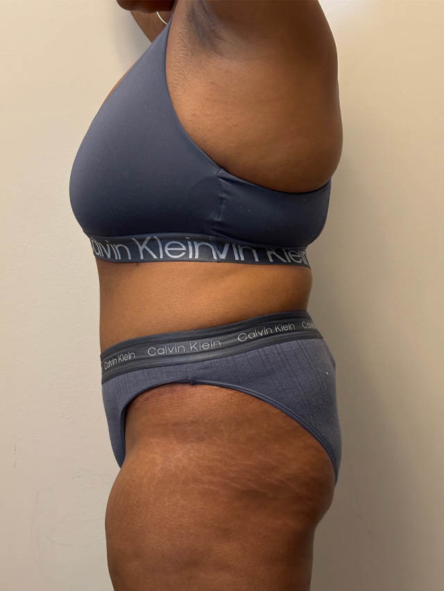 Tummy Tuck case #4852