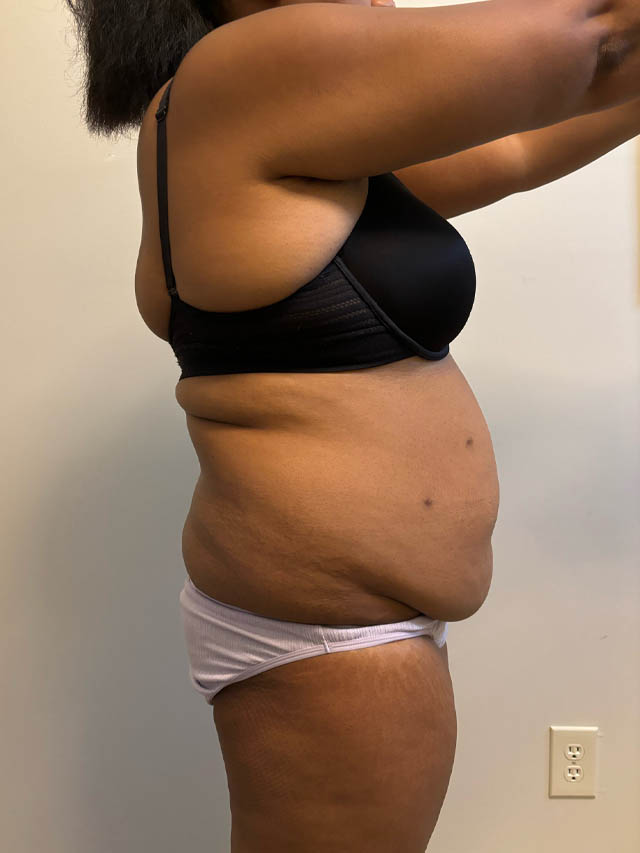 Tummy Tuck case #4852