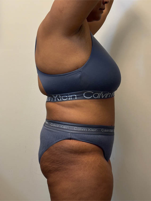 Tummy Tuck case #4852