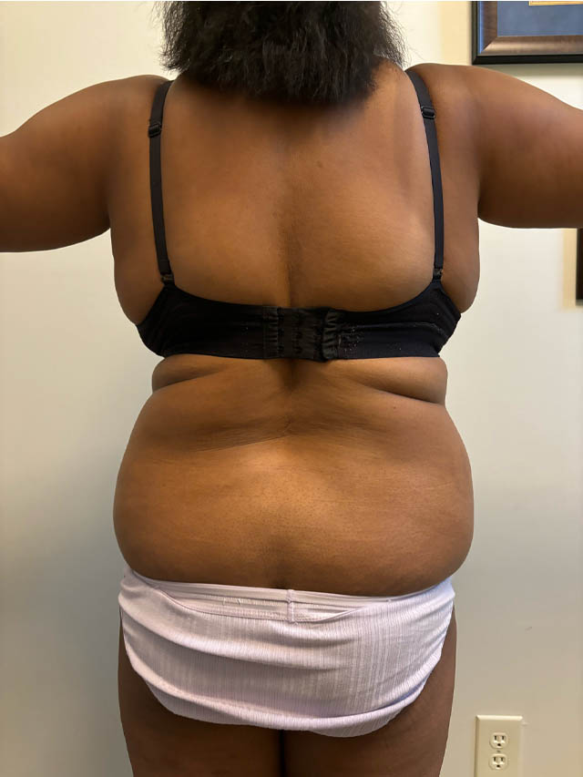 Tummy Tuck case #4852