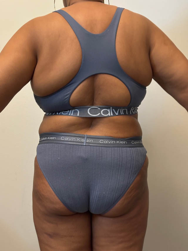 Tummy Tuck case #4852