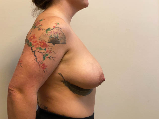 Breast Lift case #4680