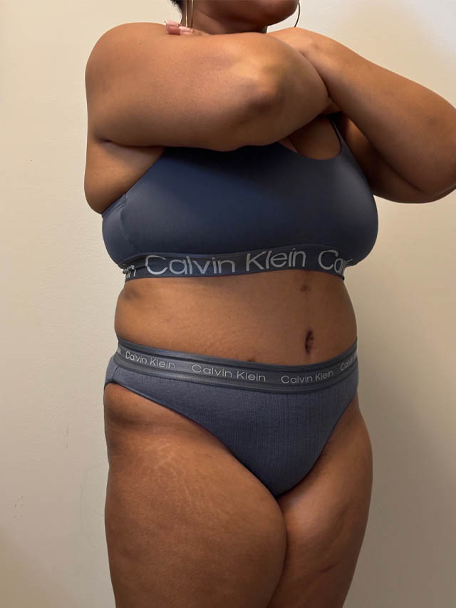 Tummy Tuck case #4852