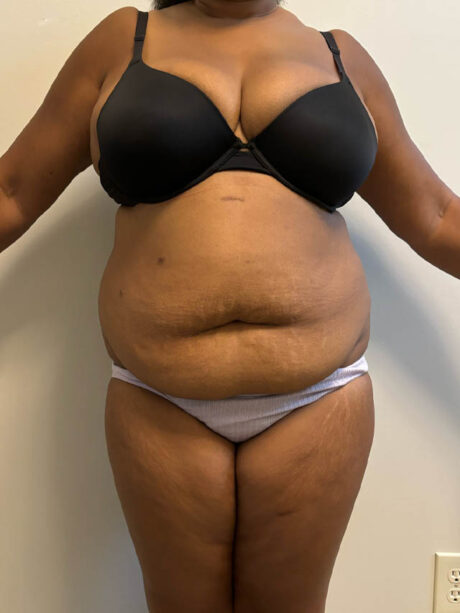 Tummy Tuck case #4852
