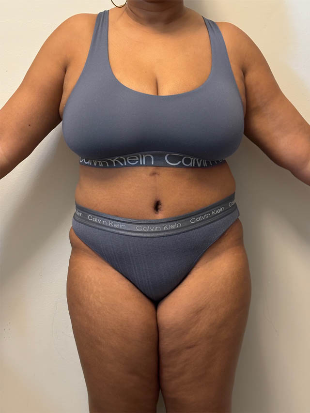 Tummy Tuck case #4852